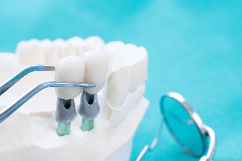 Dental implant model with crown being placed