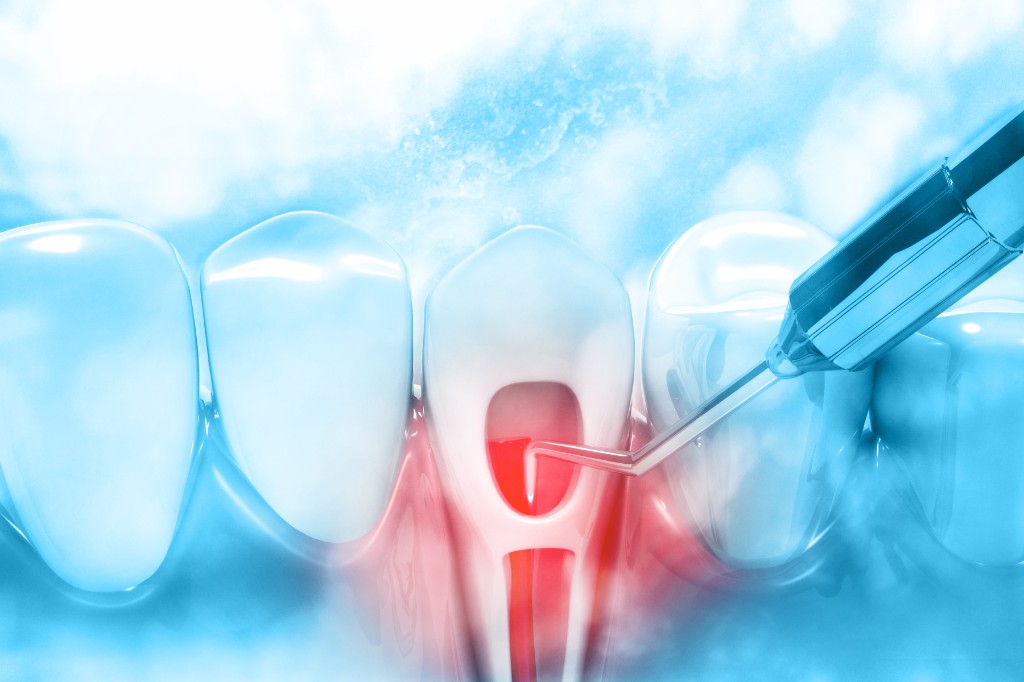 Illustration of root canal treatment inside a tooth